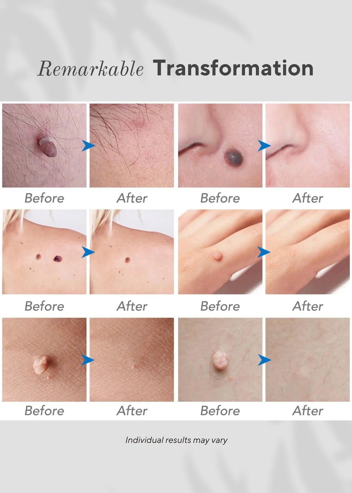 Neurova Mole And Spot Removal Pen