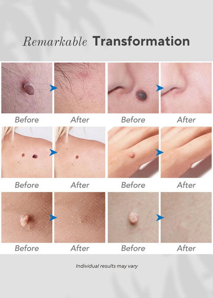 Neurova Mole And Spot Removal Pen